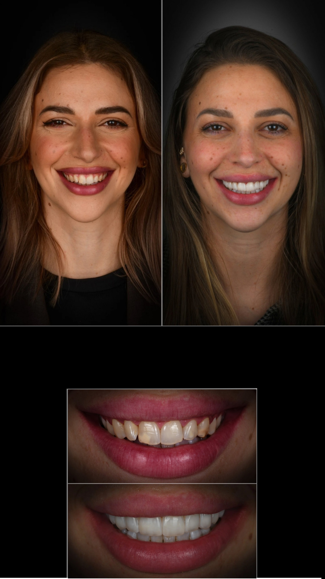 Riabilitazione completa del sorriso — prima e dopo