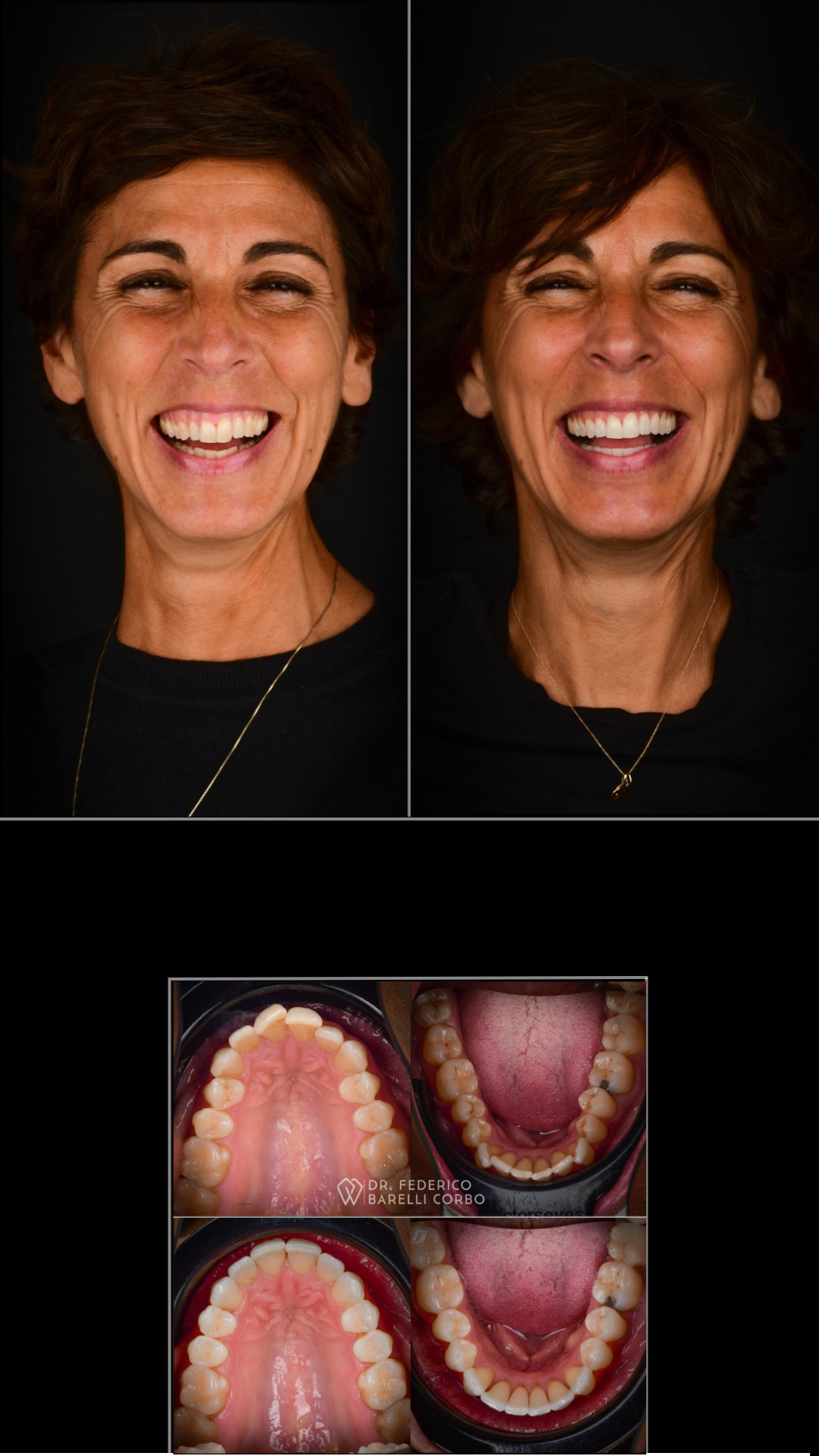 Ortodonzia con allineatori trasparenti — arcate prima e dopo